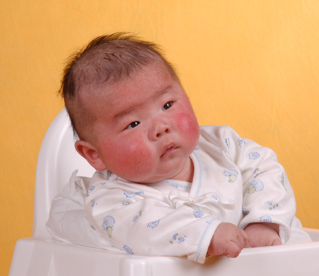 嬰兒皮膚黏膜淋巴結綜合症