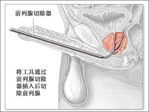前列腺切除術