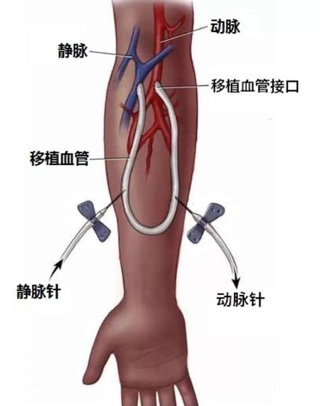 動靜脈內瘺