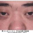Müller肌切除術 Müller肌切除術