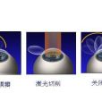 PRK手術 PRK手術