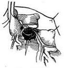 冠狀動脈解剖示意圖（剝除心包、心耳）