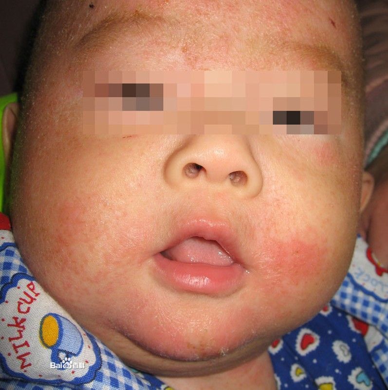 小兒過敏性濕疹