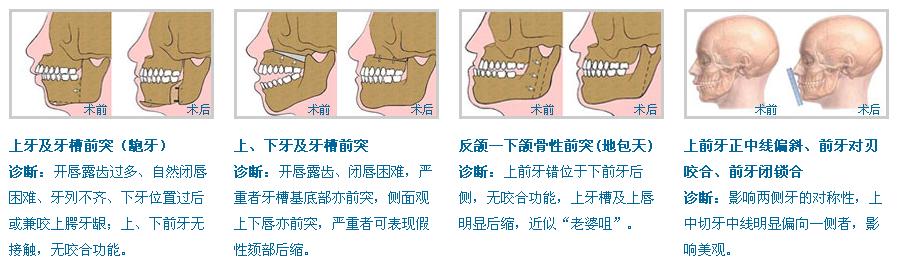 韓式外科正牙