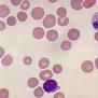 巨幼紅細胞