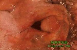 喉頭水腫引起氣管狹窄