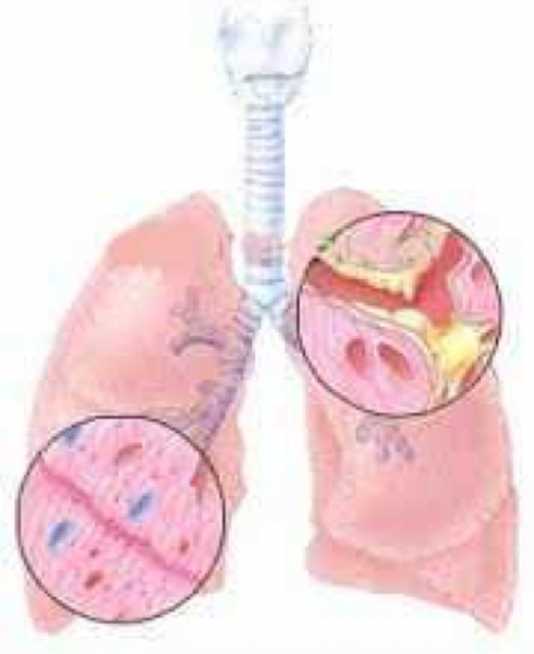 支氣管肺炎的概述