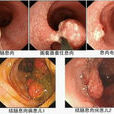 結腸息肉症 結腸息肉症
