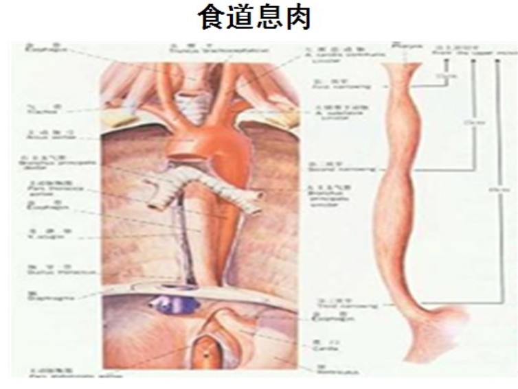 食道息肉