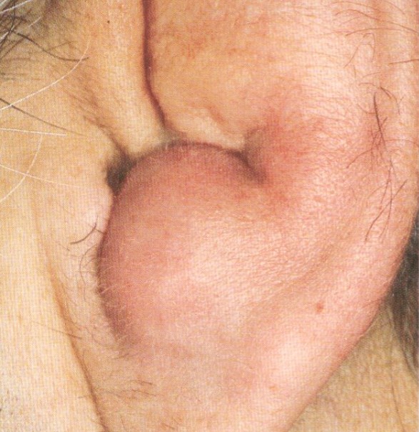 耳廓軟骨膜炎