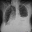 胸腔積水 胸腔積水