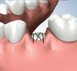 牙槽骨修整術
