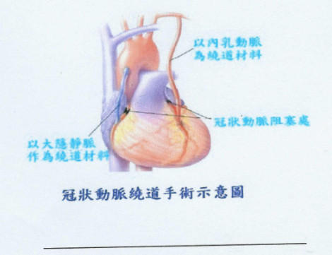 冠狀動脈繞道手術