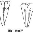 雙牙畸形 雙牙畸形