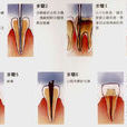 根管治療術 根管治療術