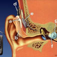 人工耳蝸技術