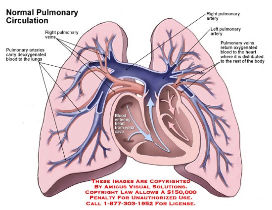 完全性肺靜脈異位引流