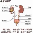 上尿路結石 上尿路結石
