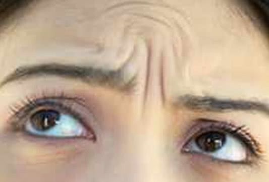 眉間皺紋 眉間皺紋