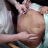 挑刺療法 挑刺療法