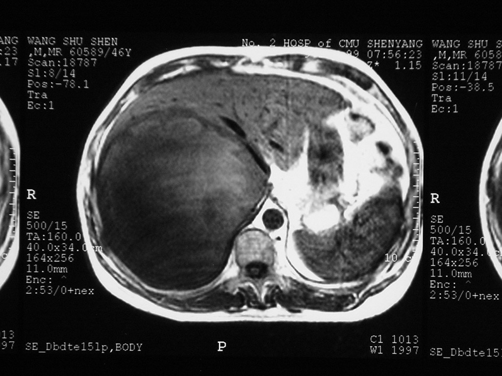 良性肝腫瘤