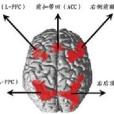 胼胝體變性 胼胝體變性