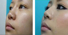鼻孔改造手術前後對比圖