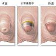包皮 包皮