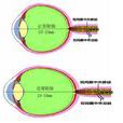 近視眼手術後遺症