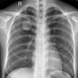 肺畸胎瘤