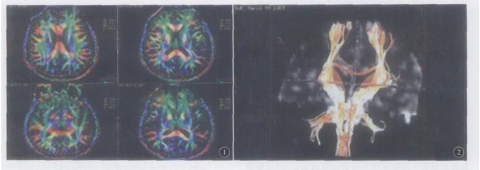 圖1 DTI圖像顯示腦白質纖維束