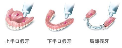 保麗淨假牙穩固劑