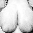乳腺肥大