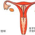 子宮內避孕器
