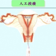 人工受精