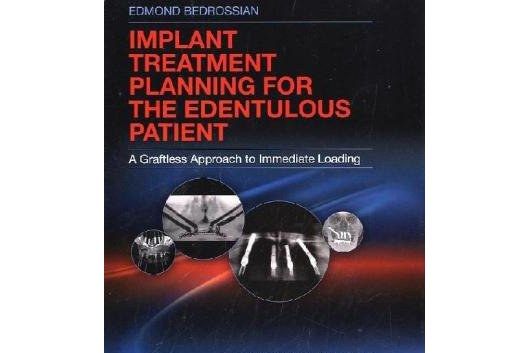 Implant Treatment Planning for the Edentulous Patient Implant Treatment Planning for the Edentulous Patient