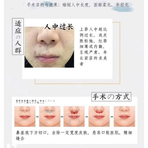 人中再造術 人中再造術