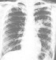 X線胸片