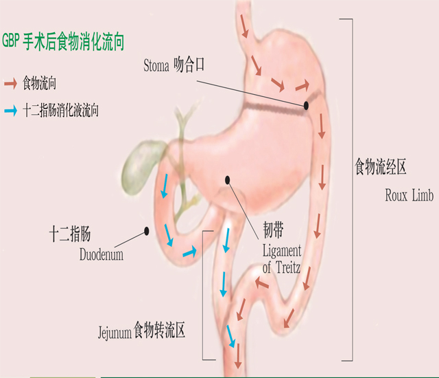 胃轉流