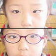 幼兒斜視 幼兒斜視