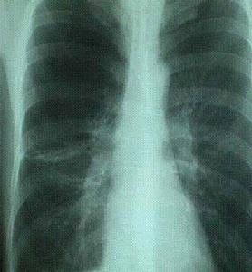《呼吸系統疾病的病理生理》