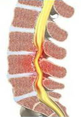椎管狹窄病理透視模擬圖