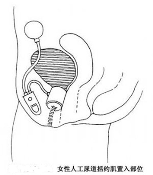 圖3 女性人工尿道植入部位