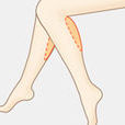 吸脂美容 吸脂美容