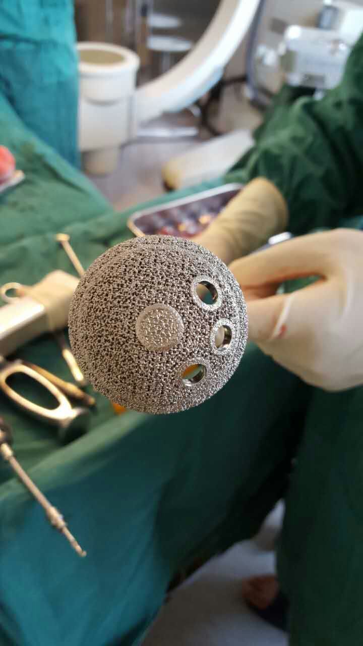 患者術中使用的3D列印金屬髖臼外杯