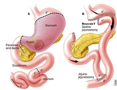 Roux-en-Y吻合