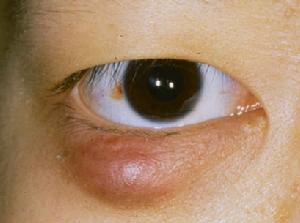 眼瞼膿腫圖