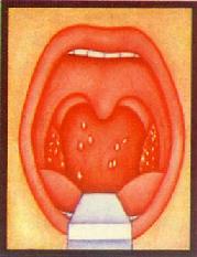 琥乙紅黴素用於治療白喉