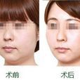 下頜脂肪袋 下頜脂肪袋
