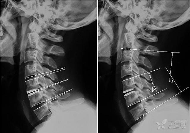 人工椎間盤置換術